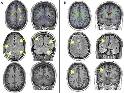 Quantification of Silent Cerebral Infarction on High-Resolution FLAIR and Cognition in Sickle Cell Anemia